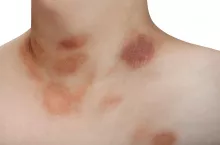 &lt;p&gt;W łupieżu Giberta najpierw na tułowiu pojawia się zmiana zwiastująca, czyli tzw. blaszka macierzysta&lt;/p&gt;