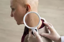 &lt;p&gt;Jesli na skórze pojawi się twardy guzek w kolorze skóry, może to oznaczać raka płaskonabłonkowego&lt;/p&gt;